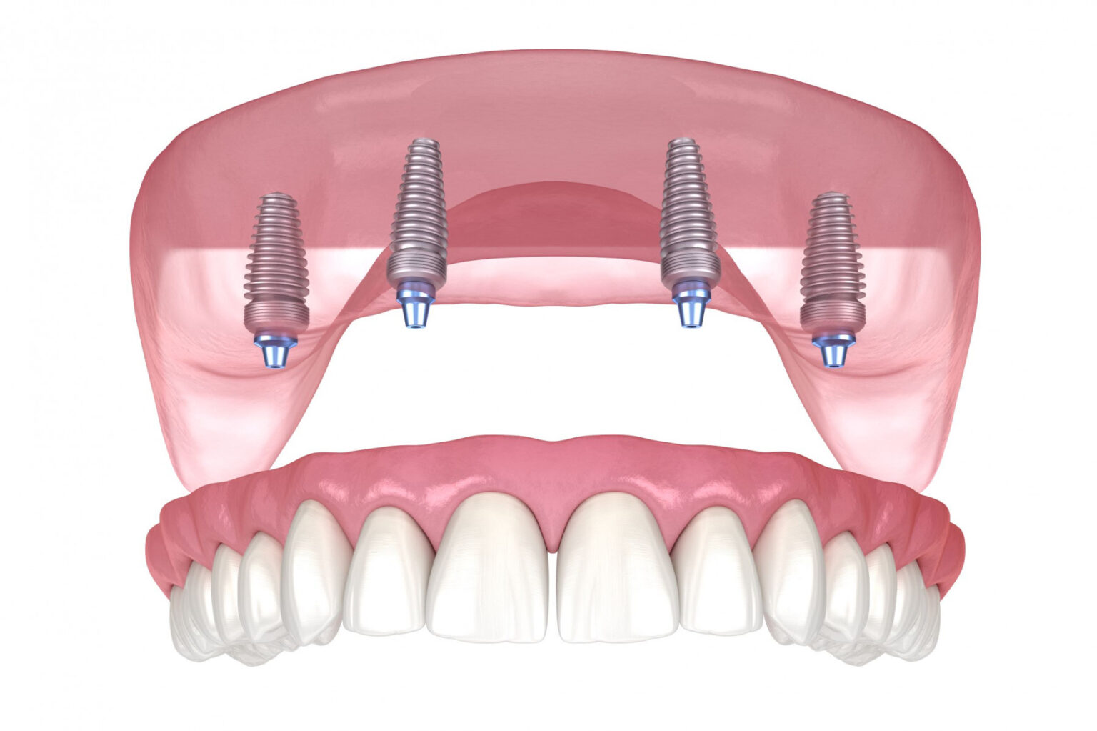 https://wellcaresolutions.al/sp/wp-content/uploads/2024/05/all-on-4-dental-implants-1536x1023-1.jpeg