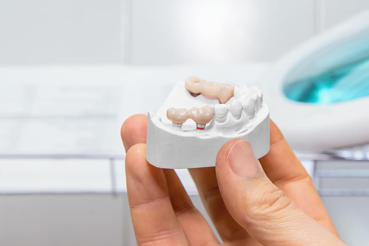 https://wellcaresolutions.al/wp-content/uploads/2024/05/how-much-does-a-dental-bridge-cost-in-ellicott-city-md-blog.jpeg